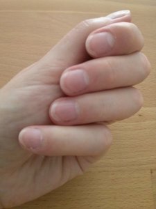 Körömmatrical eltávolítása után